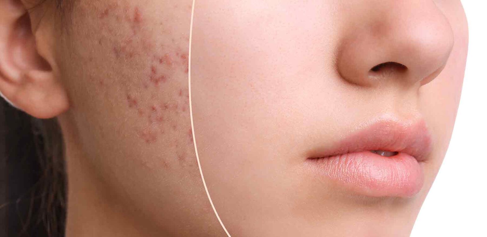 Frau mit Akne und unreiner Haut