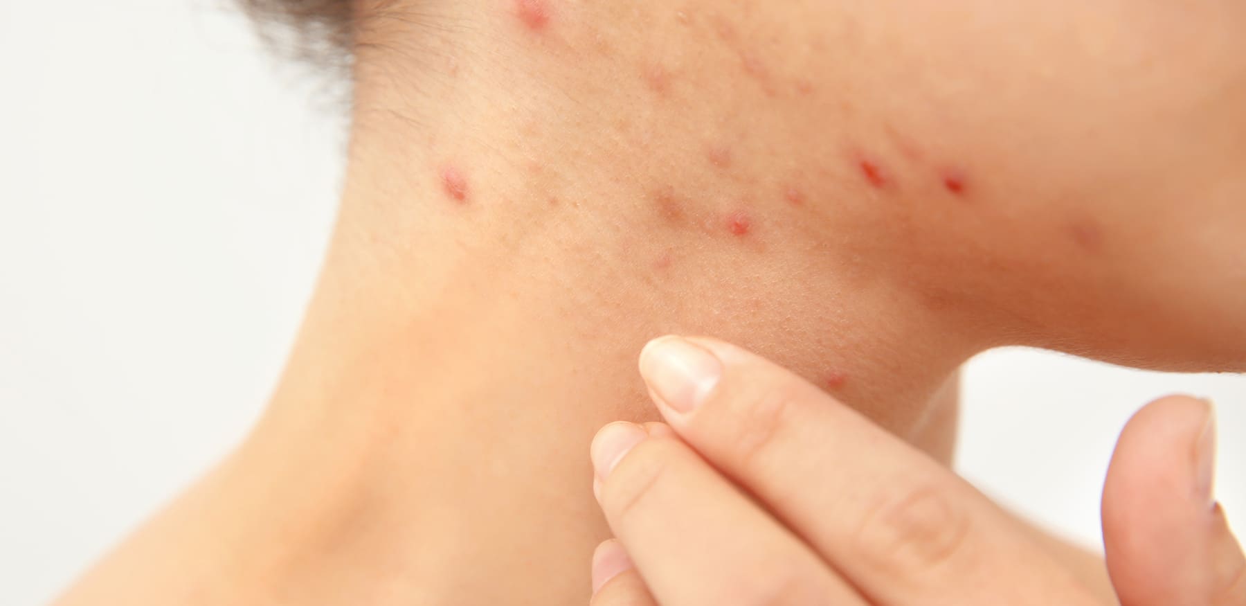 Hormonelle Akne behandeln und erkennen: 5 Tipps, die jetzt helfen