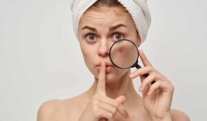 Akne bei Erwachsenen: Der Komplett-Guide zu Ursachen und der richtigen Pflege