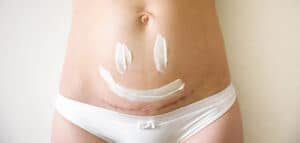 Narben aufhellen und verblassen lassen: Das hilft wirklich!