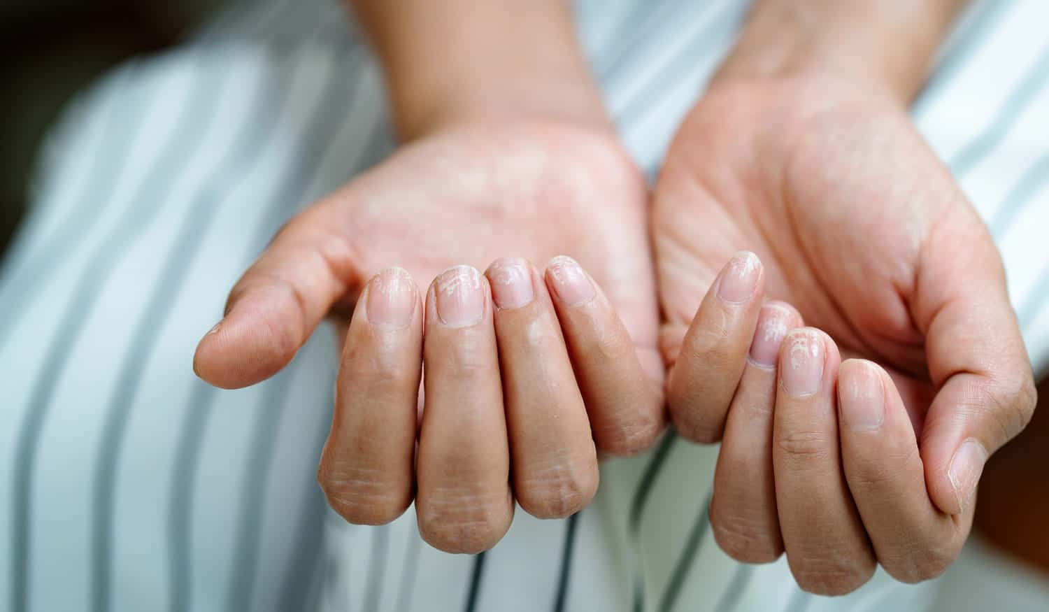 Brüchige Fingernägel in den Wechseljahren: Ursachen, Tipps und was wirklich hilft